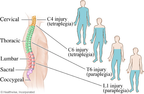 spinal cord injuries lawyer